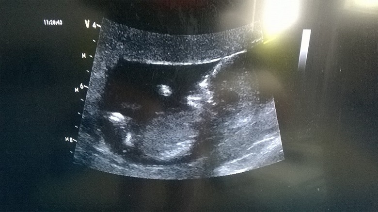 Ultrazvuk 13.týden těhotenství