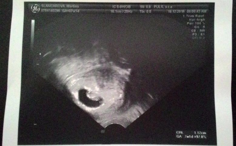 Ultrazvuk 7. týden těhotenství