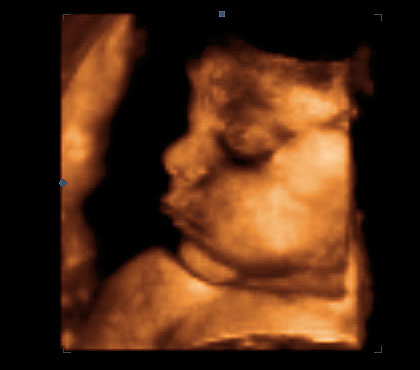 29. týden těhotenství - ultrazvuk