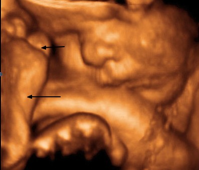 34. týden těhotenství - plod v děloze