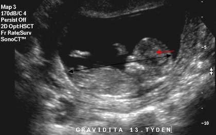 13. týden těhotenství - ultrazvukové vyšetření