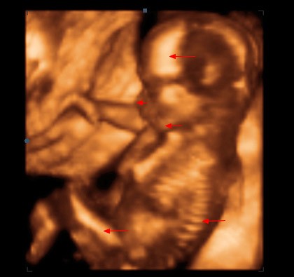 16. týden těhotenství - ultrazvuk
