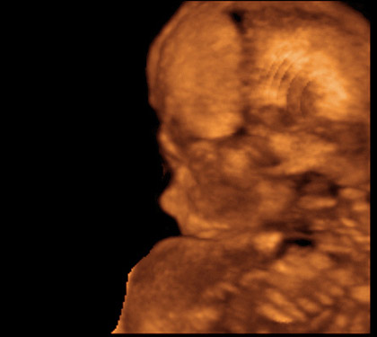 20. týden těhotenství - hlavička plodu - sono